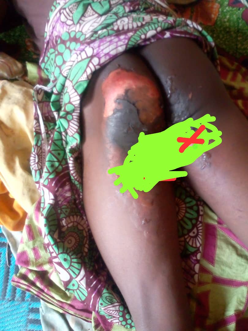 Bangolo/Accusé de vol de poulet, un paysan grièvement  brûlé  aux parties intimes.